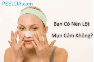 Bạn có nên lột mụn cám không