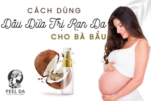 Cách Dùng Dầu Dừa Trị Rạn Da cho bà bầu