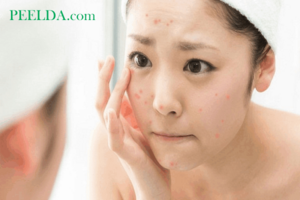 Nồng độ của Benzoyl Peroxide bao nhiêu là phù hợp